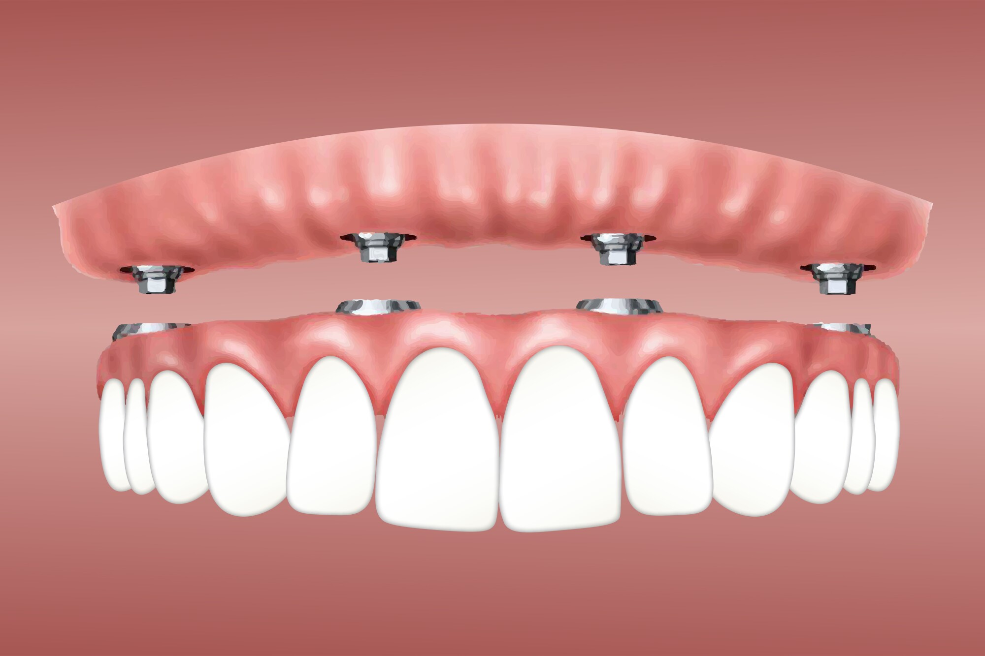 Implant Placement Procedure