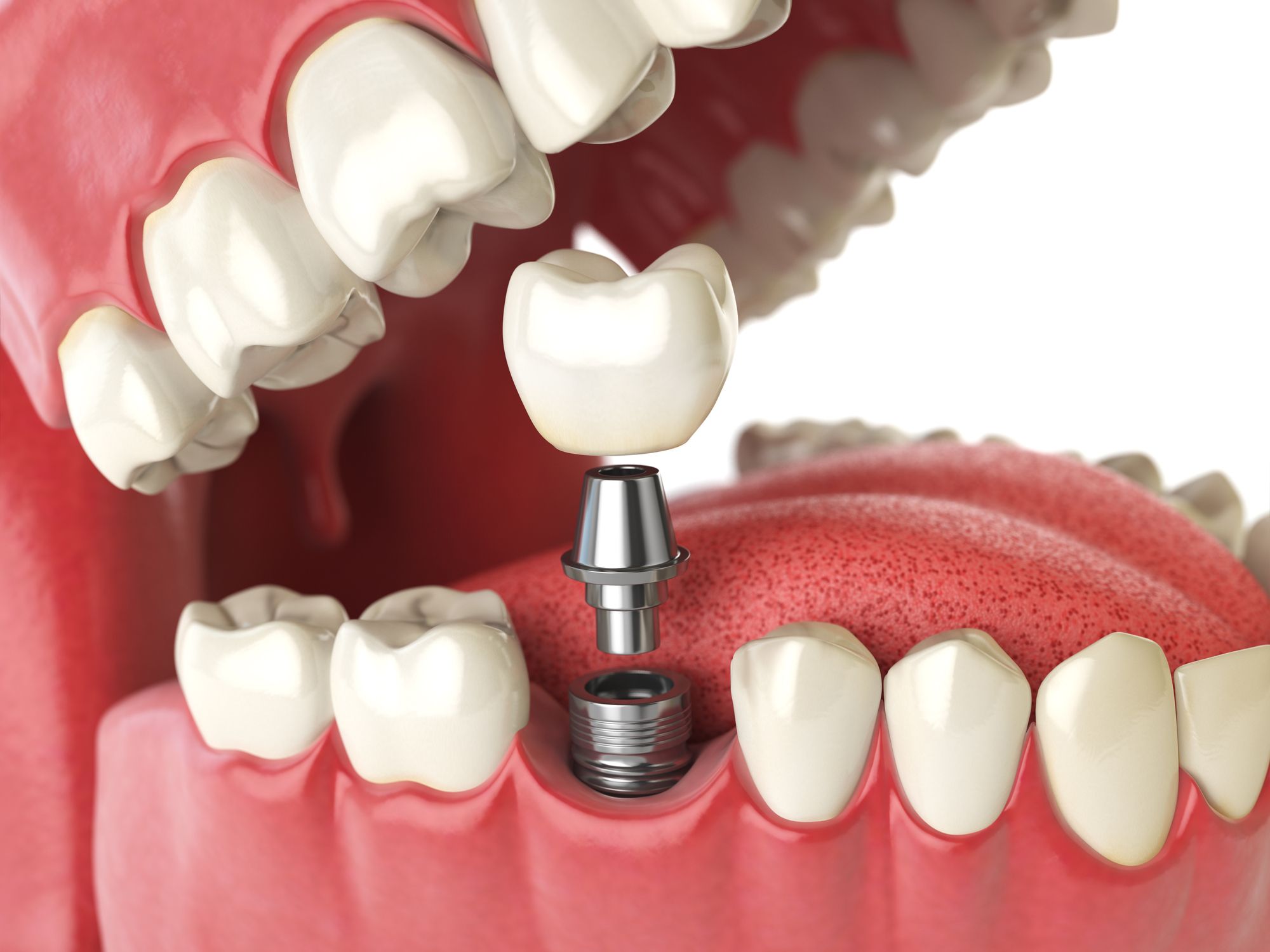 Benefits of Dental Implants