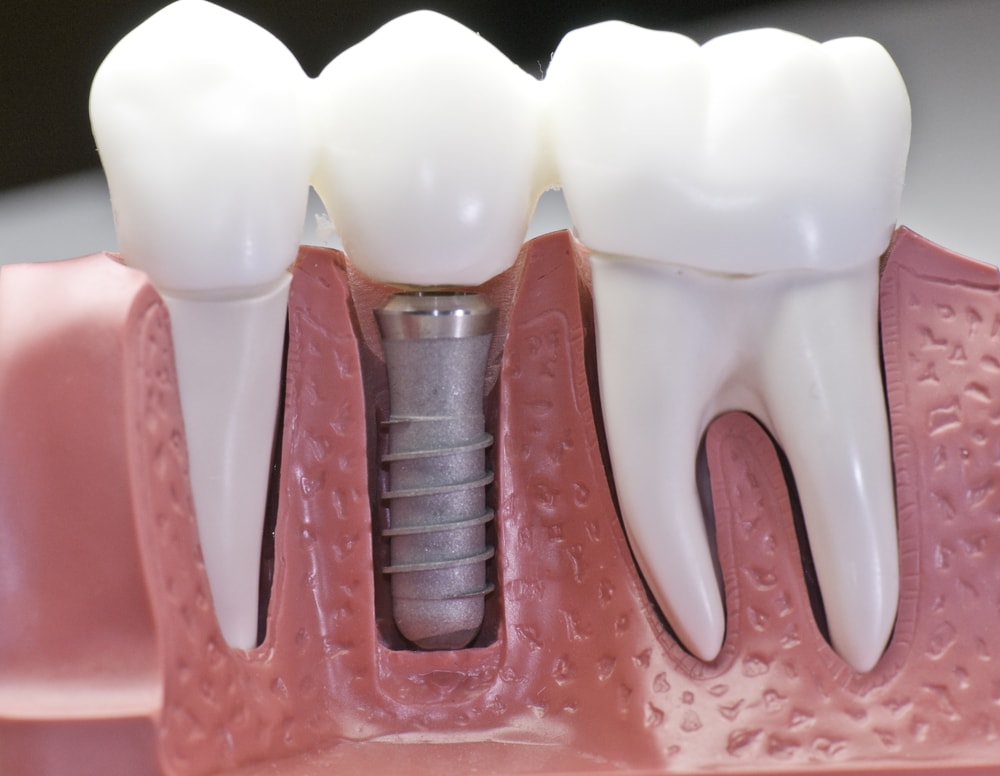 Cost-Effectiveness of Implants