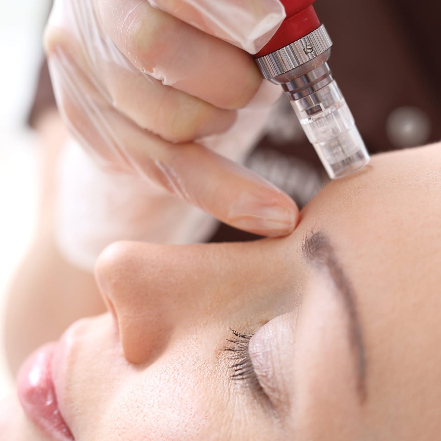 Enhancing Results With RF Microneedling