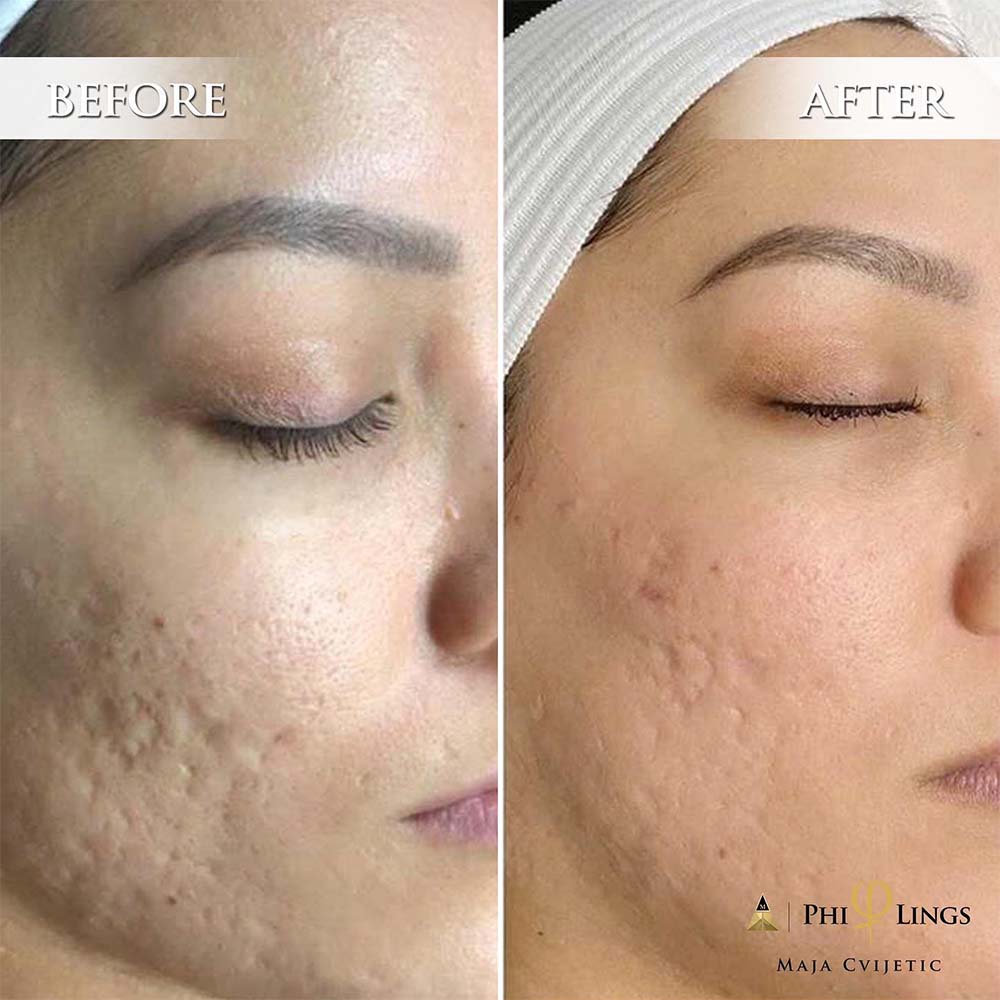 Microneedling for Acne Scars