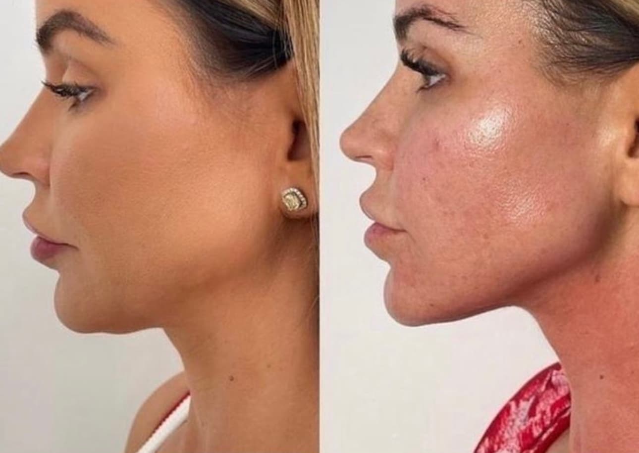 Microneedling for Acne Scars