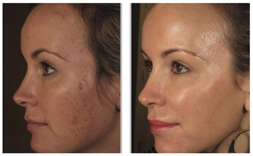 Achieving Long-Term Skin Rejuvenation