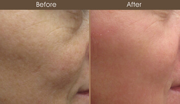 Maintaining Results Post-Treatment