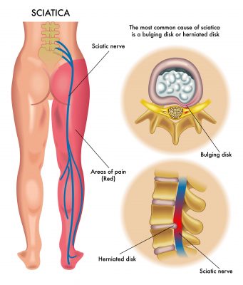 What Complications Are Associated with Sciatica?